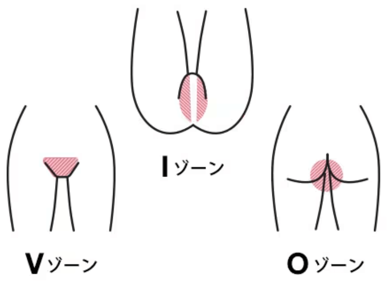 VIOゾーン